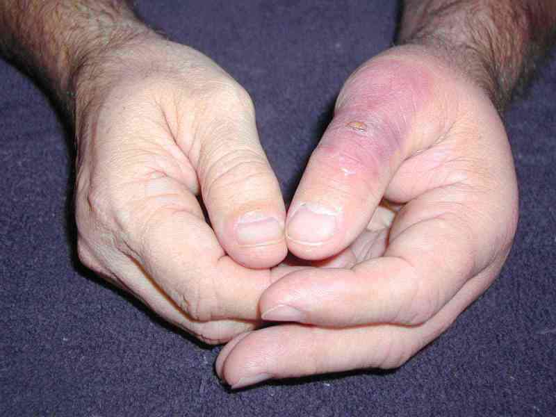 Day 3 after being bitten