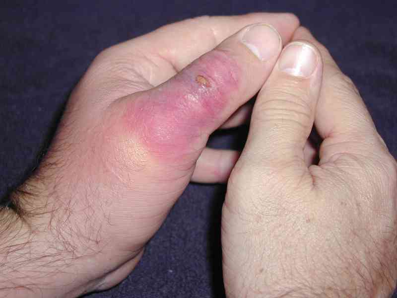 Day 4 after being bitten