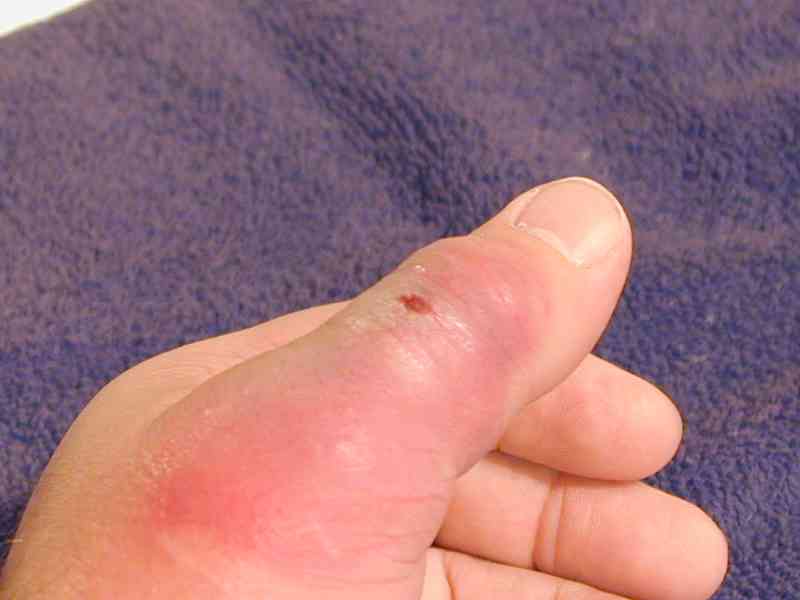 Day 5 after being bitten